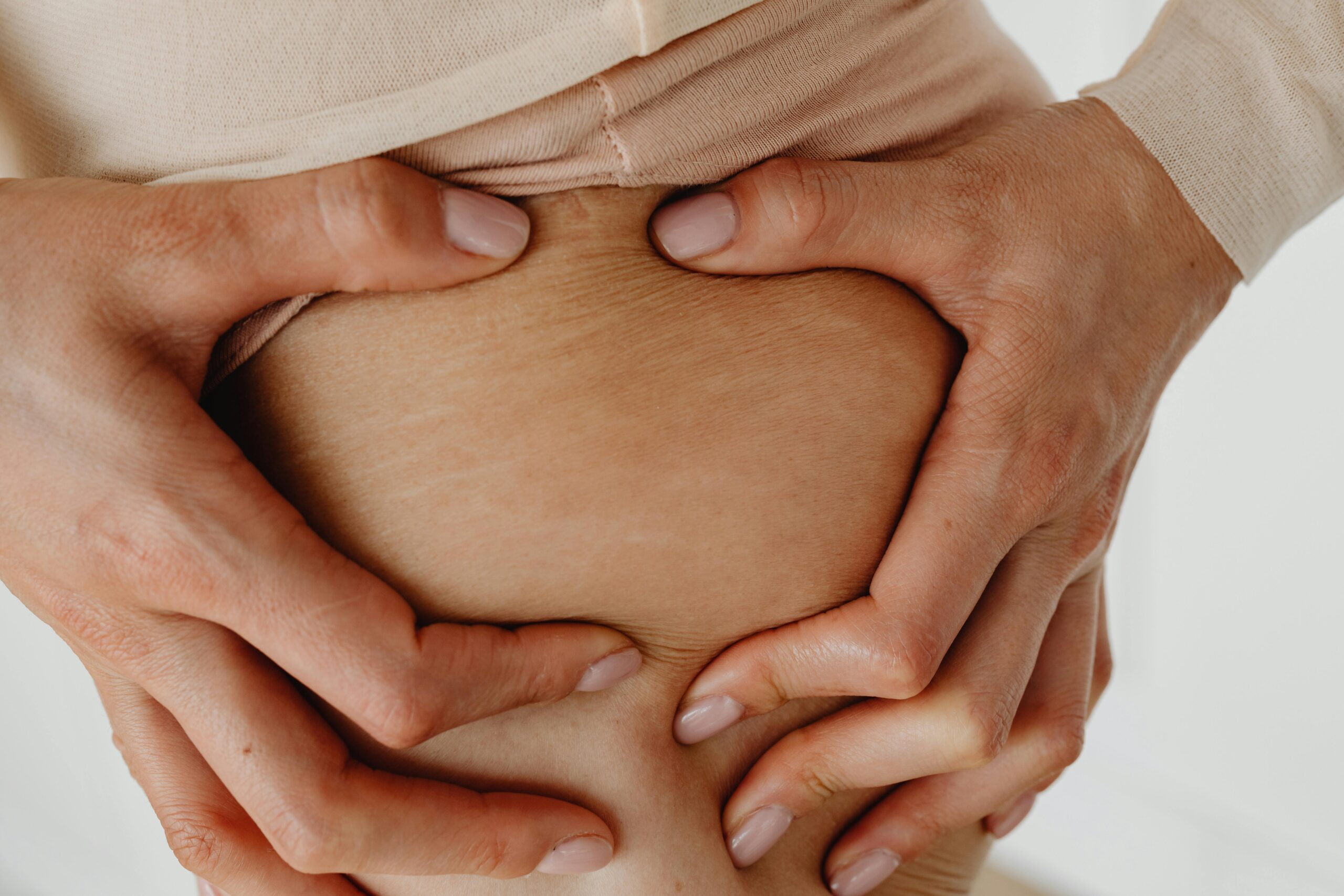 Woman with stretchmarks